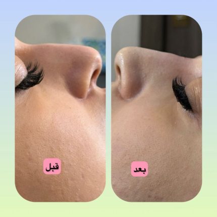 فیلر بینی لاهیجان