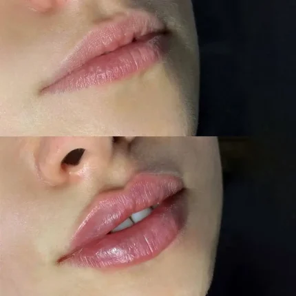 فیلر لب لاهیجان