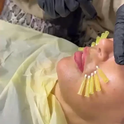 فیلم نخ جوانسازی صورت